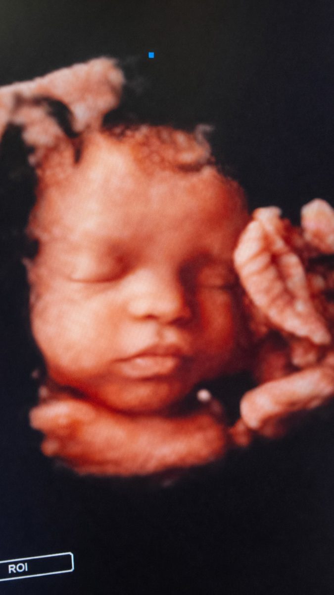3D sonogram showing a baby's hand near the face.