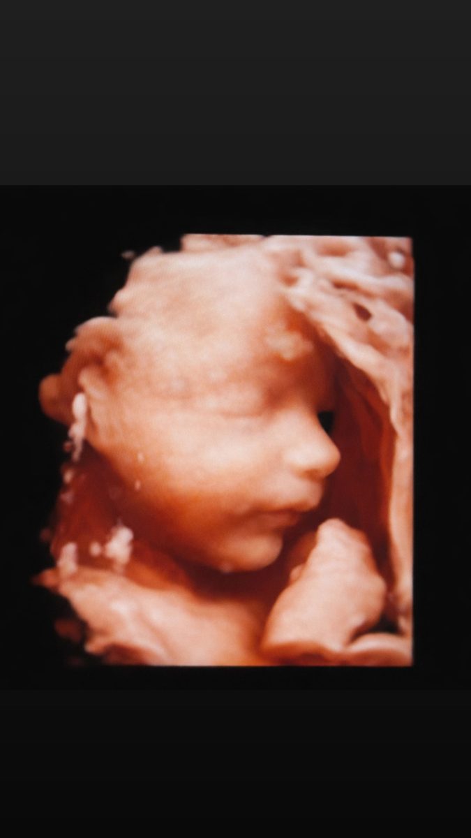 3D sonogram of a baby in profile.
